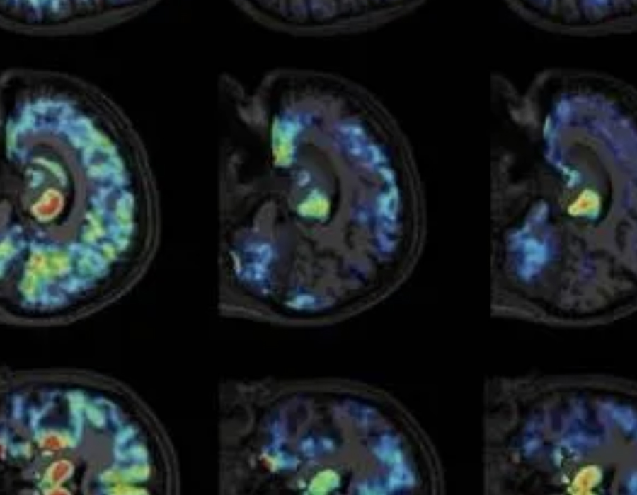 Coma : une découverte va permettre (enfin) d’évaluer les chances de réveil