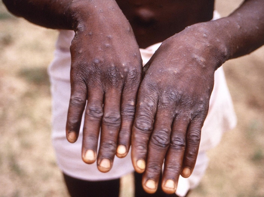 Variole du singe : 32 cas enregistrés en Côte d’Ivoire
